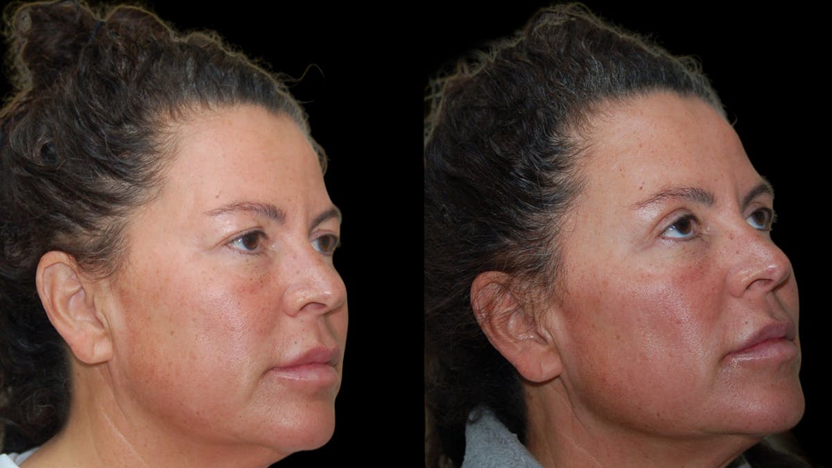 Upper Eyelid Surgery Before & After Gallery - Patient 855219 - Image 6