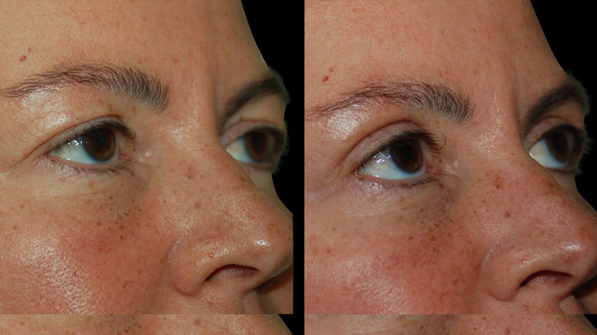 Upper Eyelid Surgery Before & After Gallery - Patient 855219 - Image 7