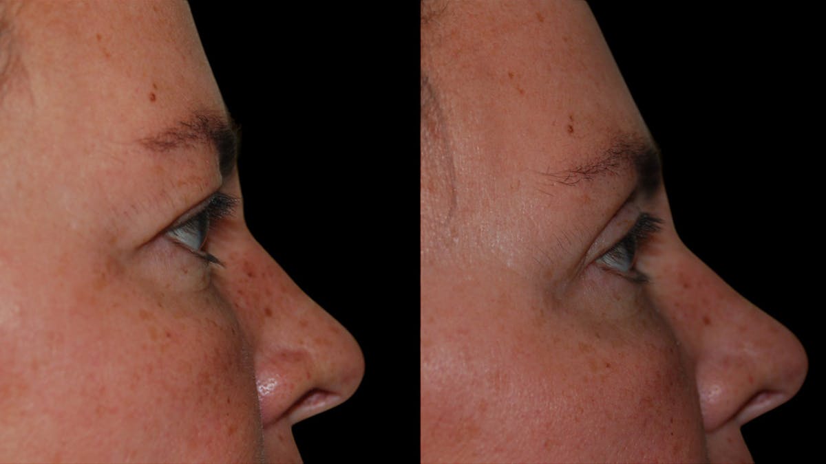 Upper Eyelid Surgery Before & After Gallery - Patient 855219 - Image 8
