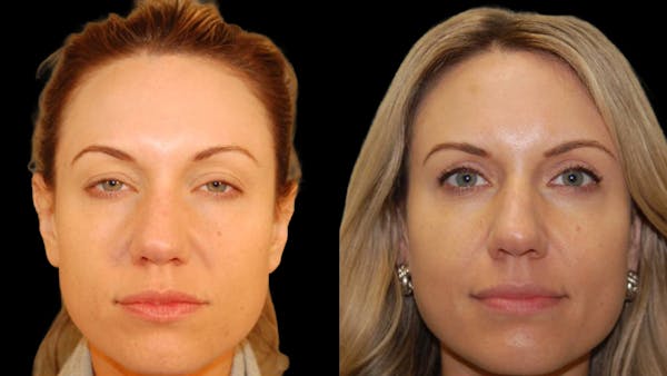 Upper Eyelid Surgery Before & After Gallery - Patient 987394 - Image 1
