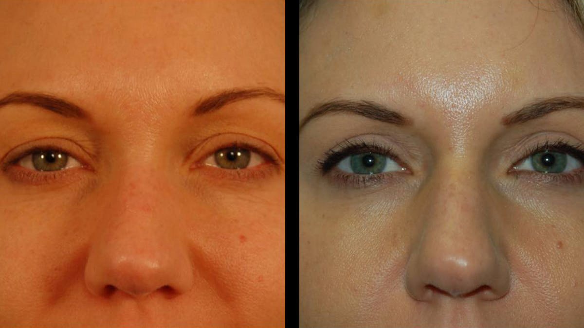 Upper Eyelid Surgery Before & After Gallery - Patient 987394 - Image 2