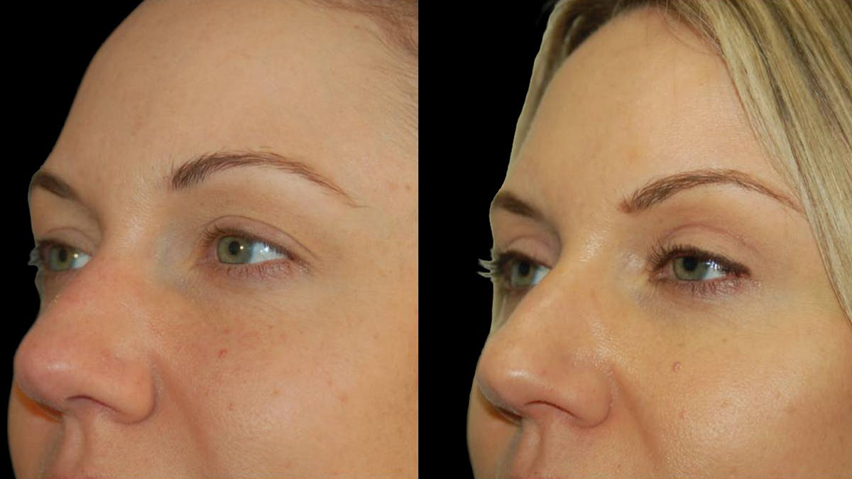 Upper Eyelid Surgery Before & After Gallery - Patient 987394 - Image 3