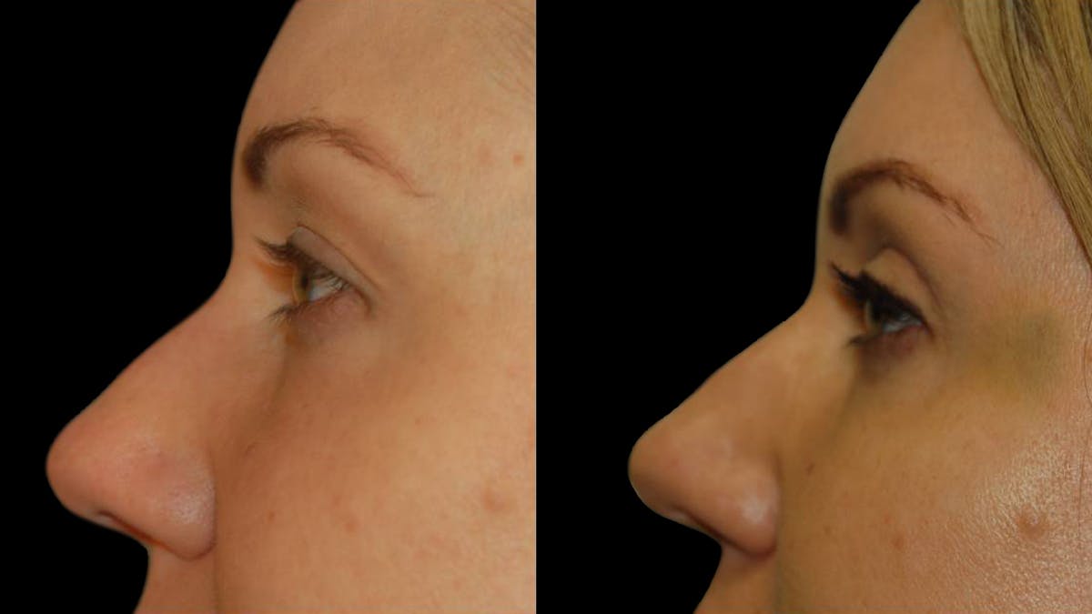 Upper Eyelid Surgery Before & After Gallery - Patient 987394 - Image 4