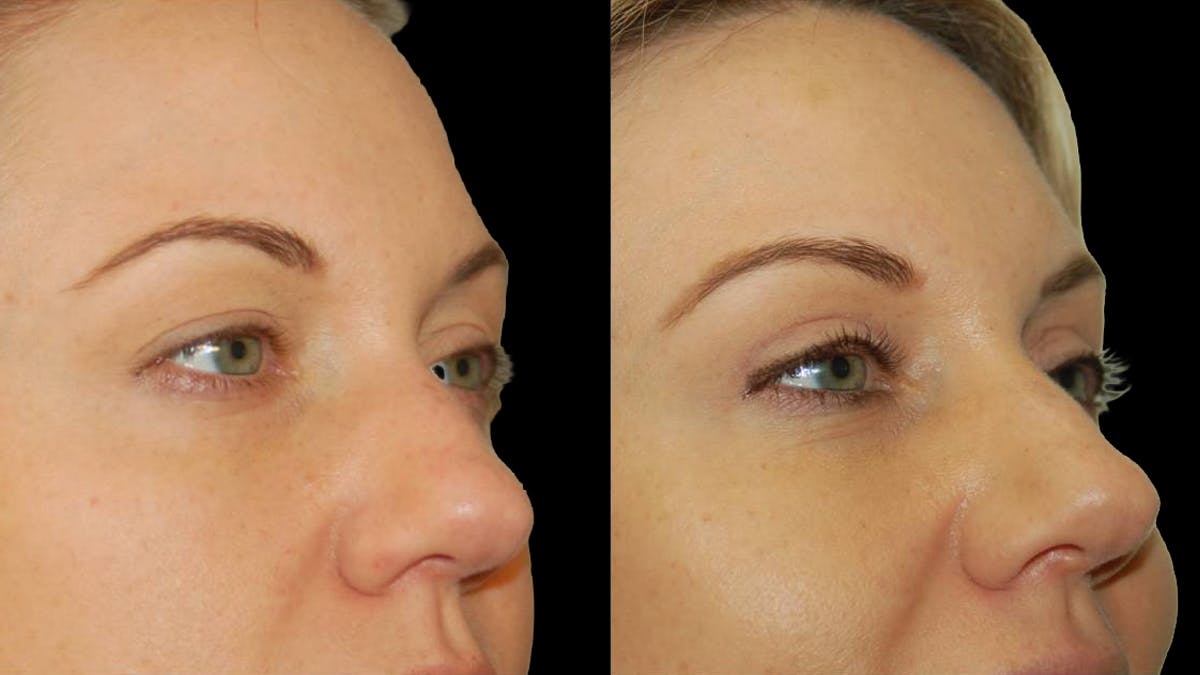 Upper Eyelid Surgery Before & After Gallery - Patient 987394 - Image 5