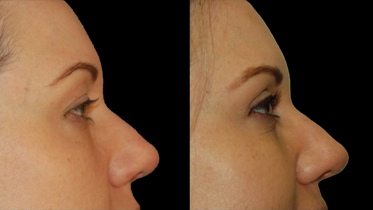 Upper Eyelid Surgery Before & After Gallery - Patient 987394 - Image 6