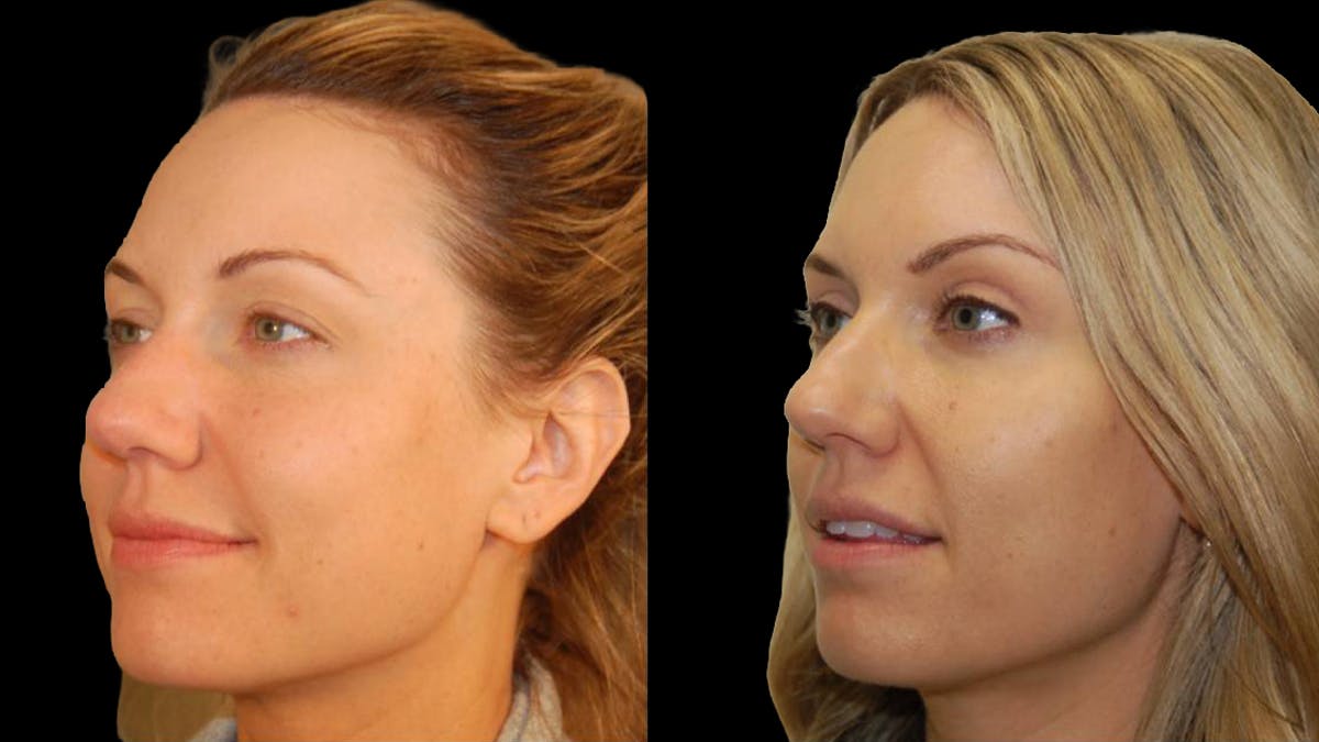 Upper Eyelid Surgery Before & After Gallery - Patient 987394 - Image 7