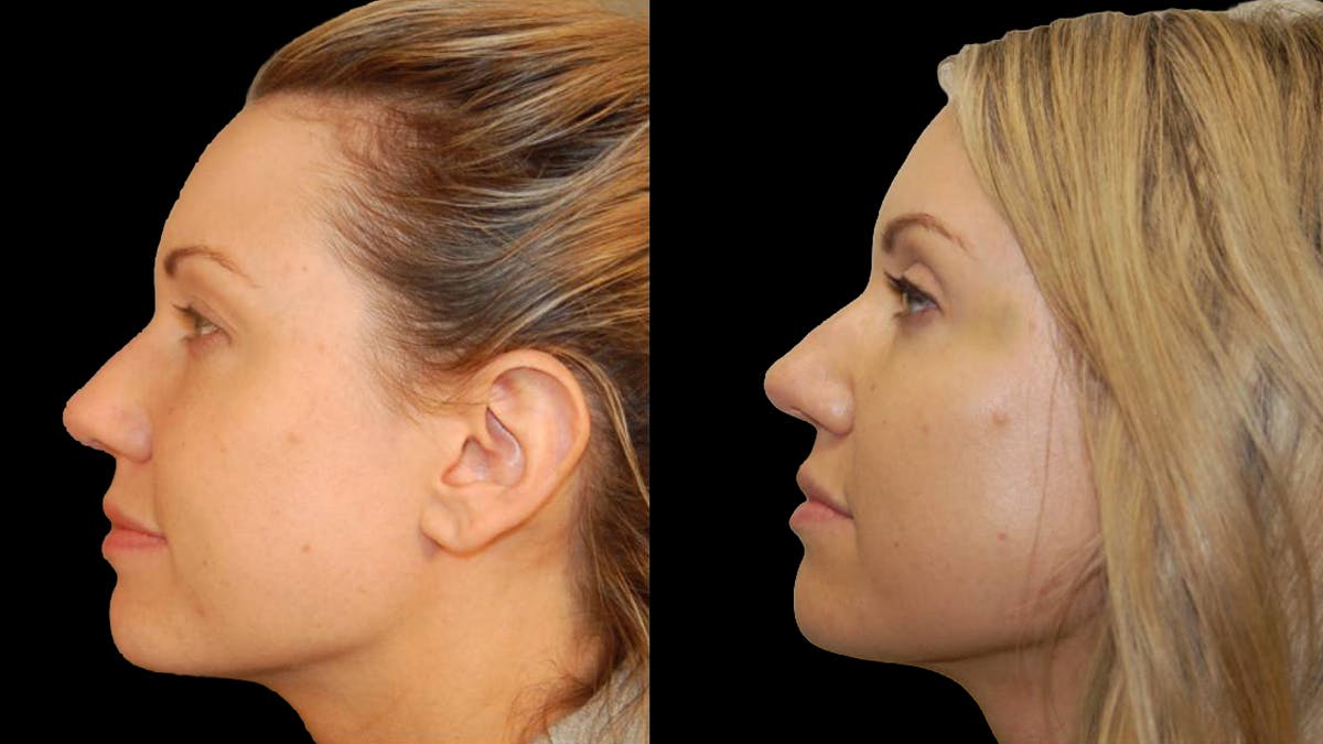 Upper Eyelid Surgery Before & After Gallery - Patient 987394 - Image 8