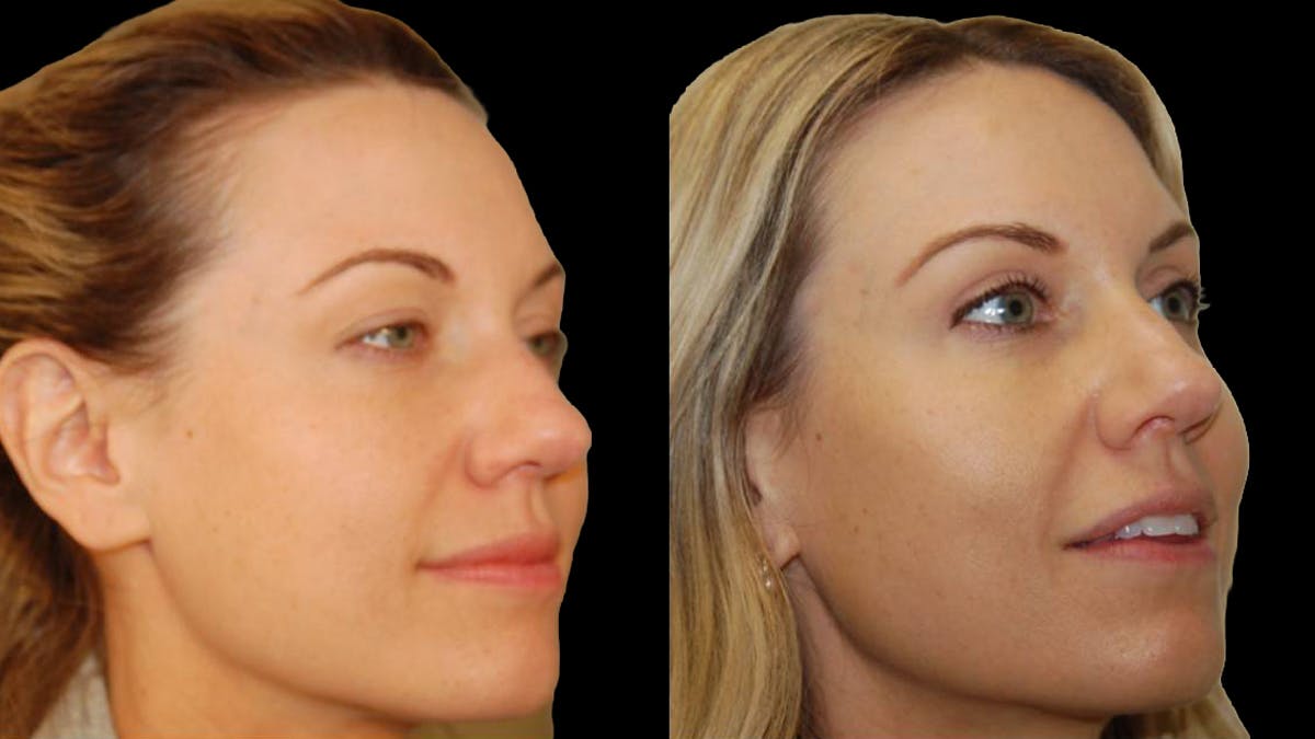 Upper Eyelid Surgery Before & After Gallery - Patient 987394 - Image 9
