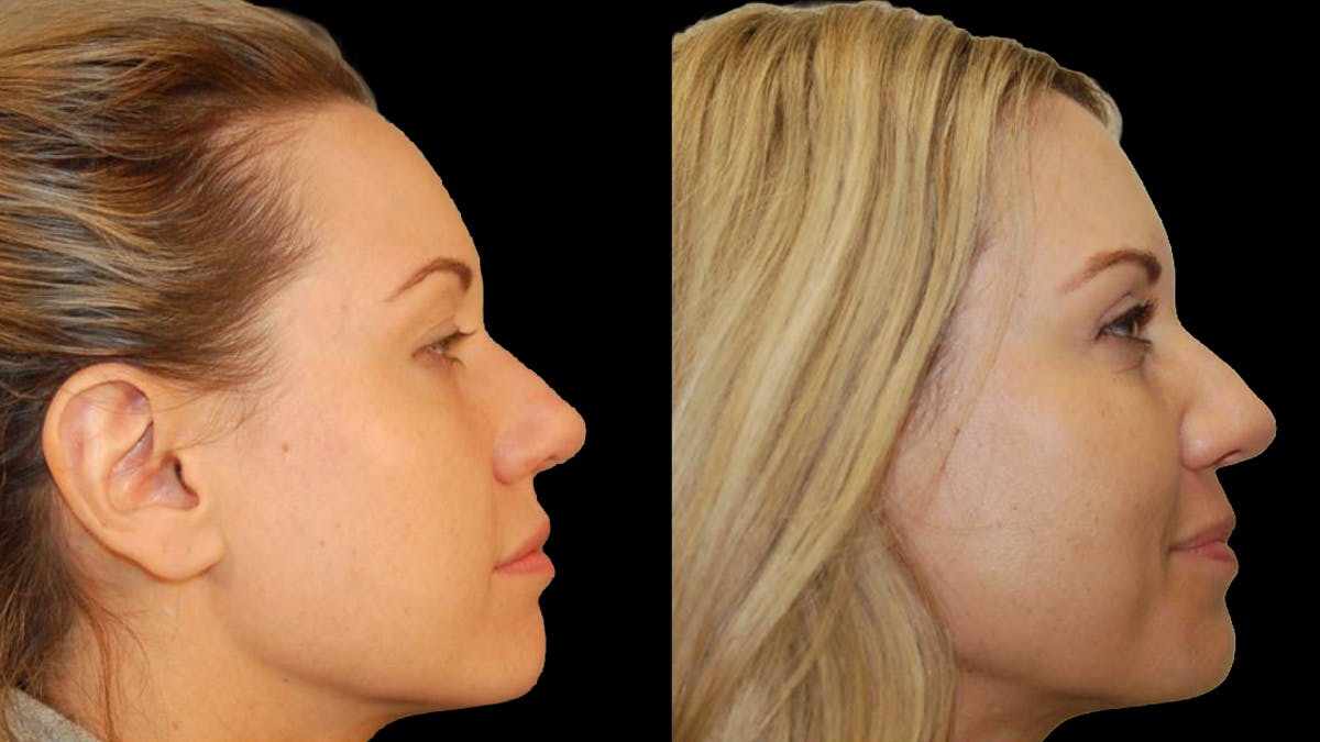 Upper Eyelid Surgery Before & After Gallery - Patient 987394 - Image 10