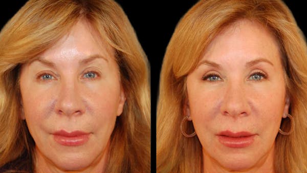 Upper Eyelid Surgery Before & After Gallery - Patient 295689 - Image 1