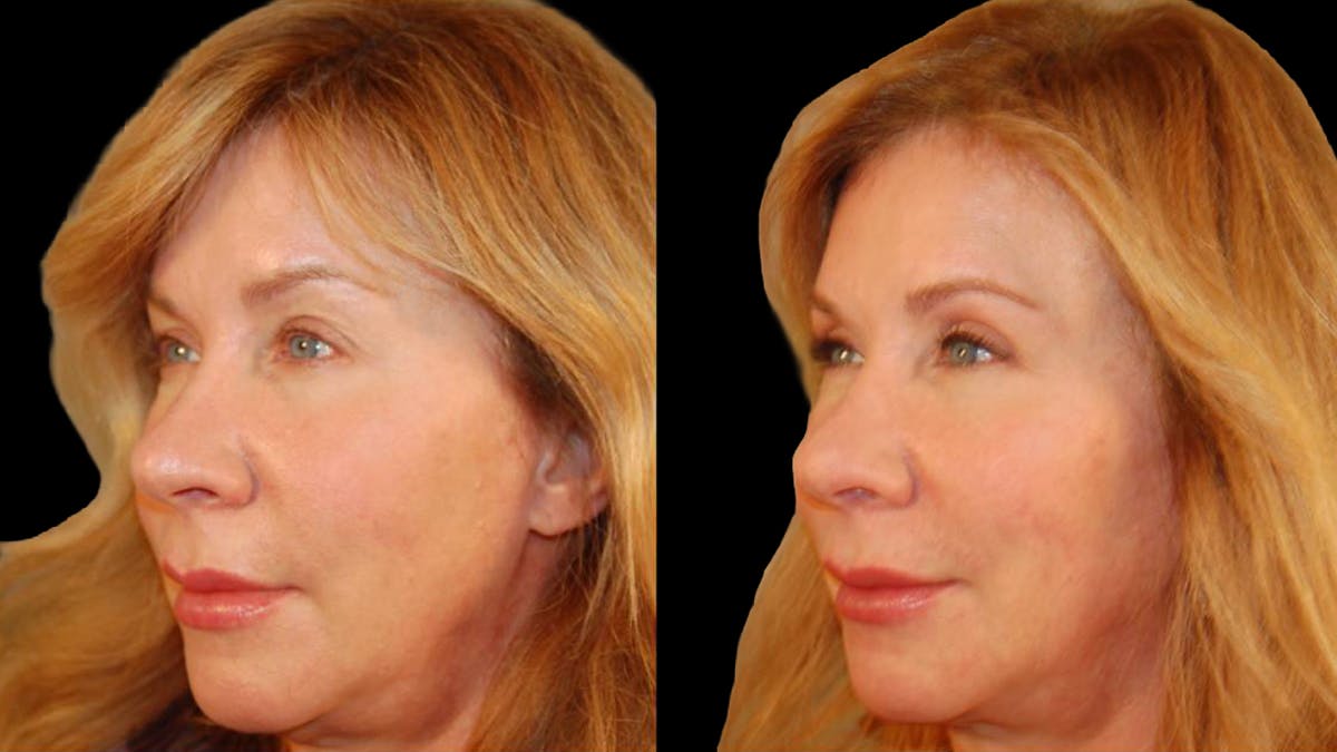 Upper Eyelid Surgery Before & After Gallery - Patient 295689 - Image 2