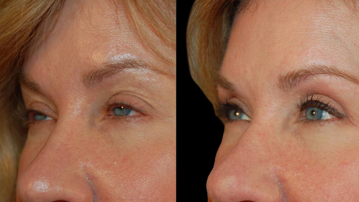 Upper Eyelid Surgery Before & After Gallery - Patient 295689 - Image 3