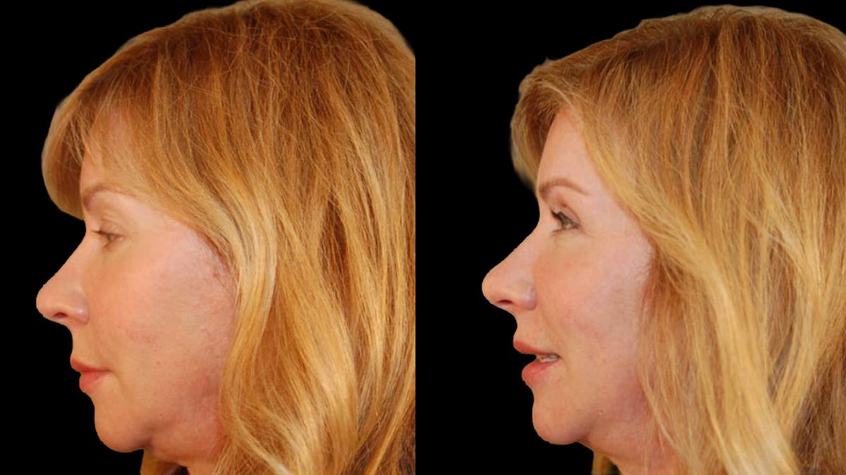 Upper Eyelid Surgery Before & After Gallery - Patient 295689 - Image 4