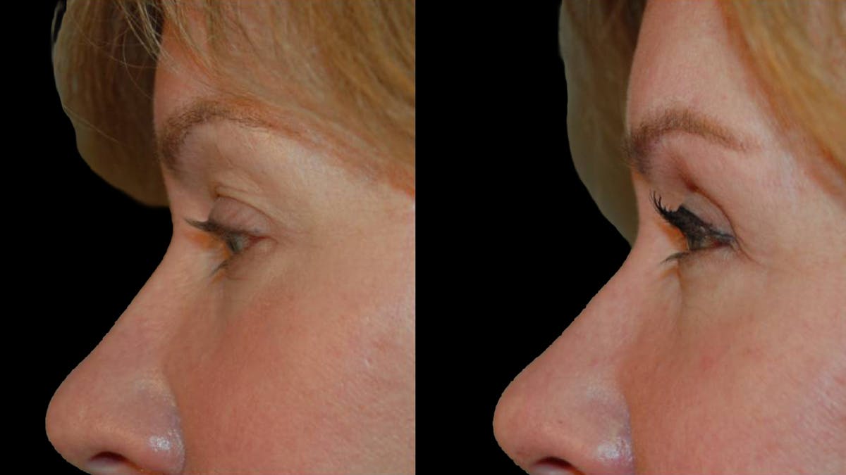 Upper Eyelid Surgery Before & After Gallery - Patient 295689 - Image 5