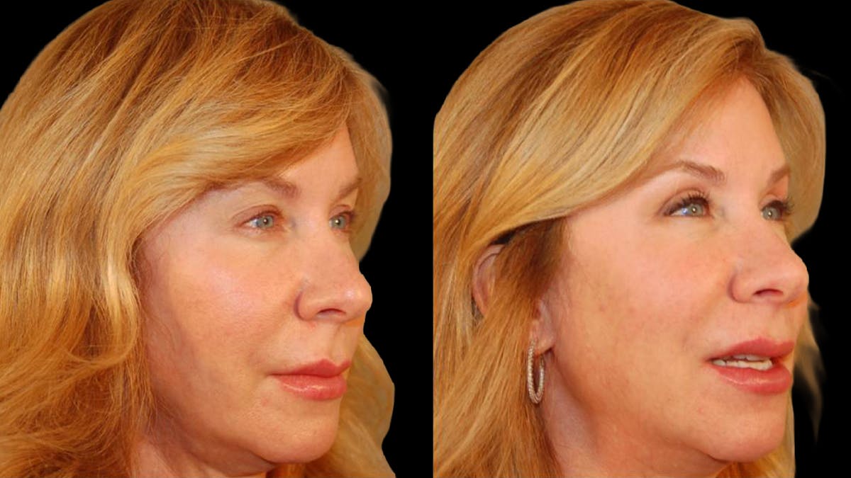 Upper Eyelid Surgery Before & After Gallery - Patient 295689 - Image 6