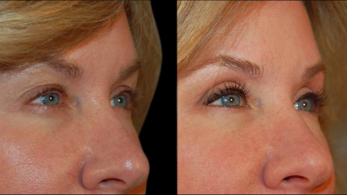 Upper Eyelid Surgery Before & After Gallery - Patient 295689 - Image 7