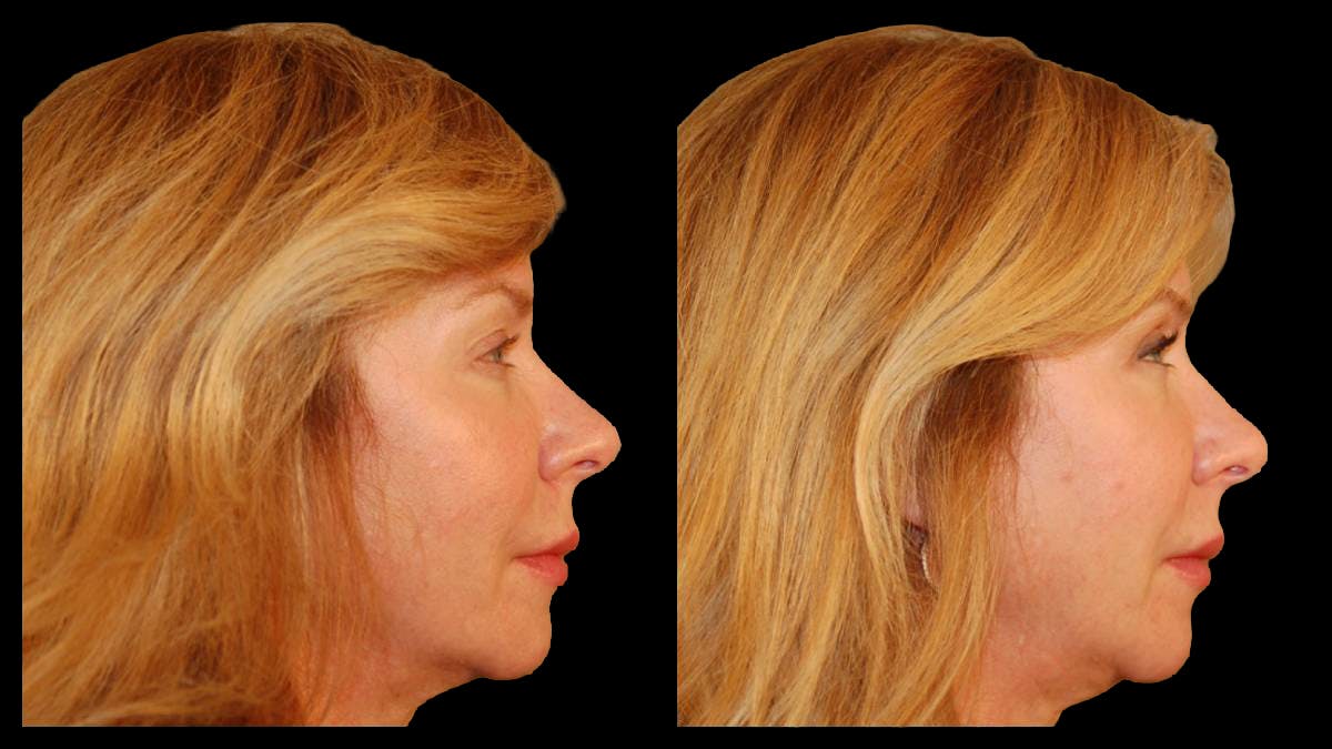Upper Eyelid Surgery Before & After Gallery - Patient 295689 - Image 8