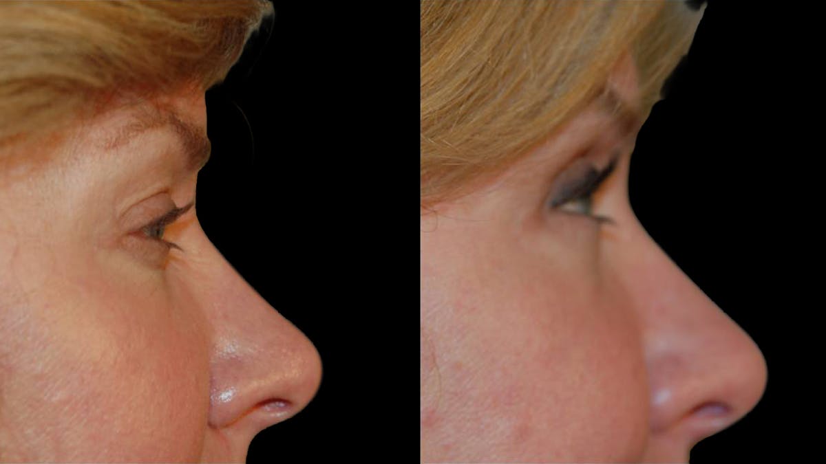 Upper Eyelid Surgery Before & After Gallery - Patient 295689 - Image 9
