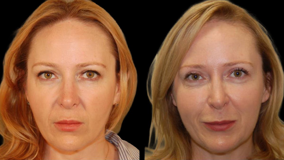 Upper Eyelid Surgery Before & After Gallery - Patient 117667 - Image 1