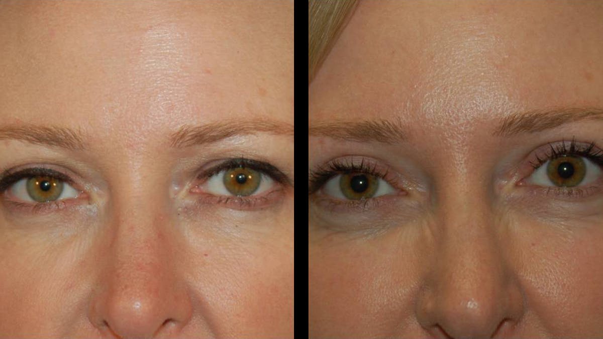 Upper Eyelid Surgery Before & After Gallery - Patient 117667 - Image 2