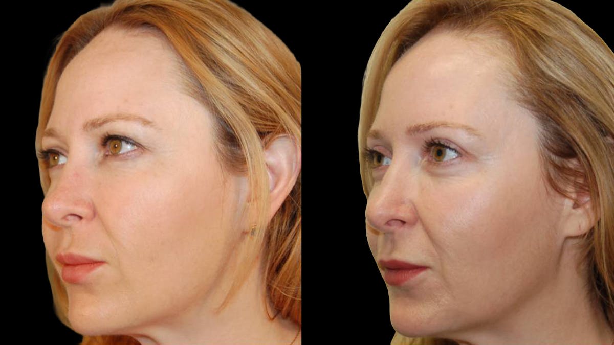 Upper Eyelid Surgery Before & After Gallery - Patient 117667 - Image 3