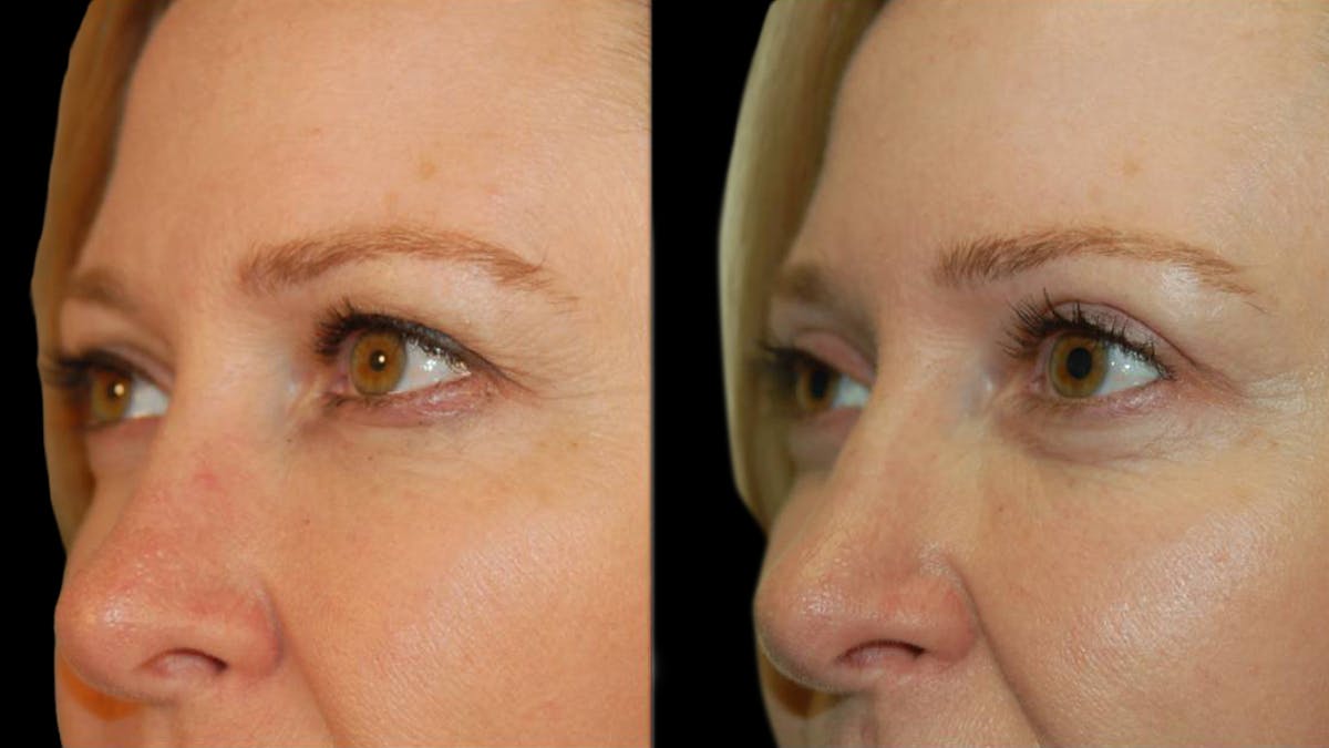 Upper Eyelid Surgery Before & After Gallery - Patient 117667 - Image 4