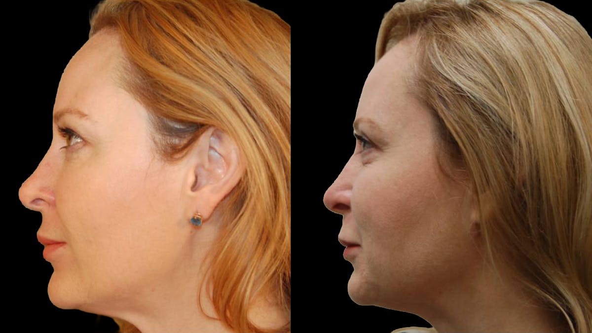 Upper Eyelid Surgery Before & After Gallery - Patient 117667 - Image 5