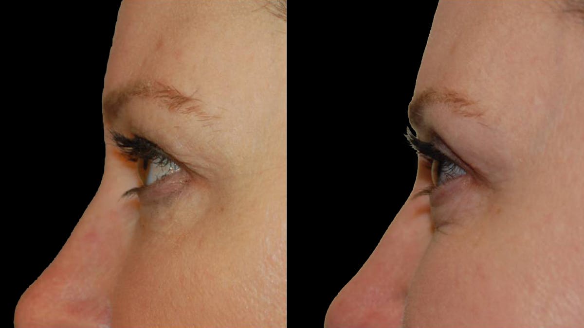 Upper Eyelid Surgery Before & After Gallery - Patient 117667 - Image 6
