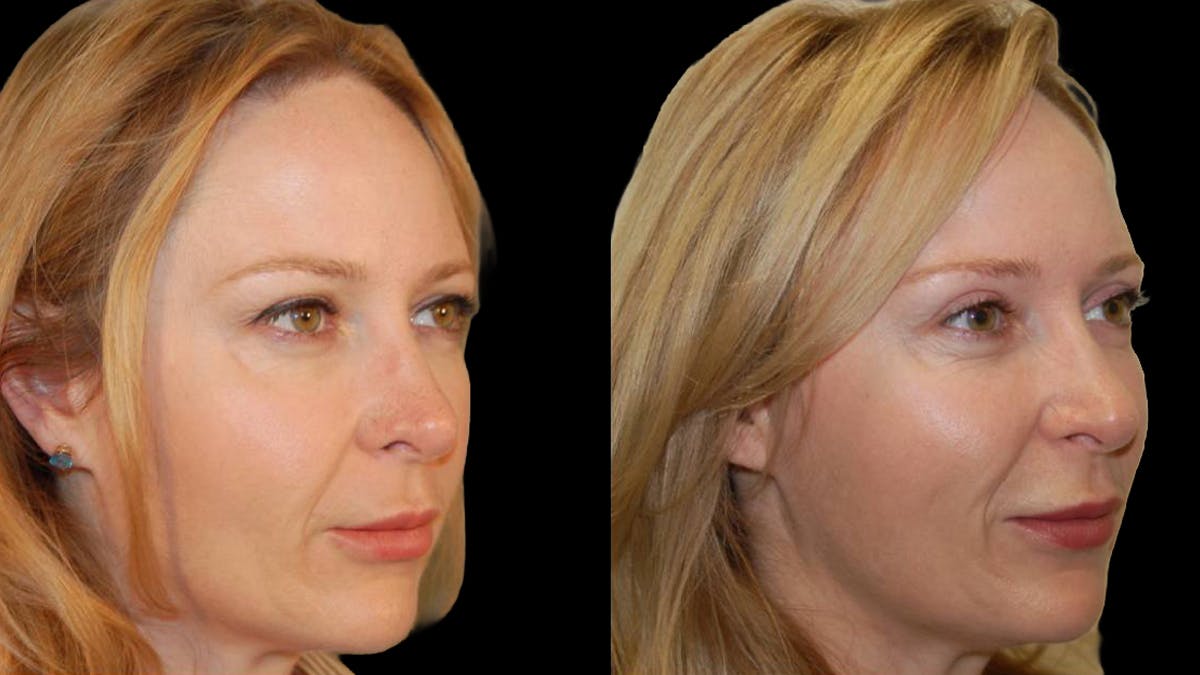 Upper Eyelid Surgery Before & After Gallery - Patient 117667 - Image 7