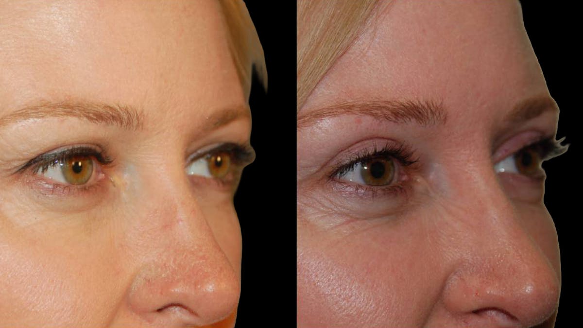 Upper Eyelid Surgery Before & After Gallery - Patient 117667 - Image 8