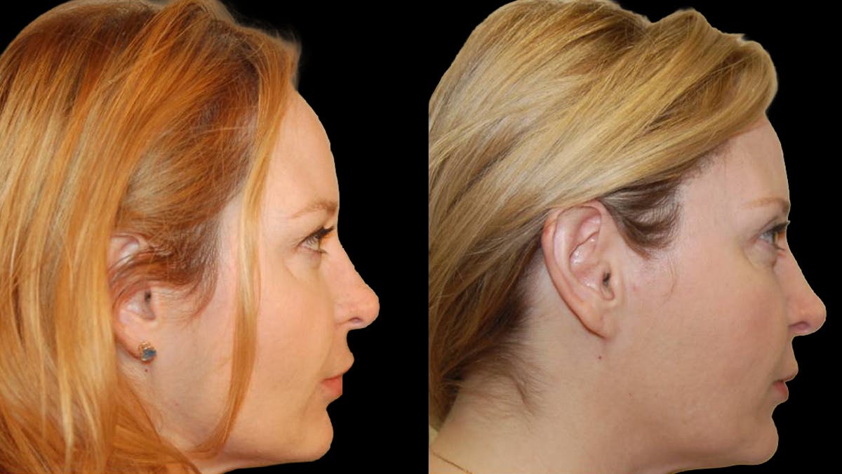 Upper Eyelid Surgery Before & After Gallery - Patient 117667 - Image 9