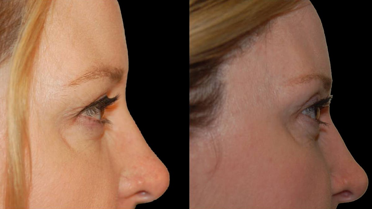 Upper Eyelid Surgery Before & After Gallery - Patient 117667 - Image 10