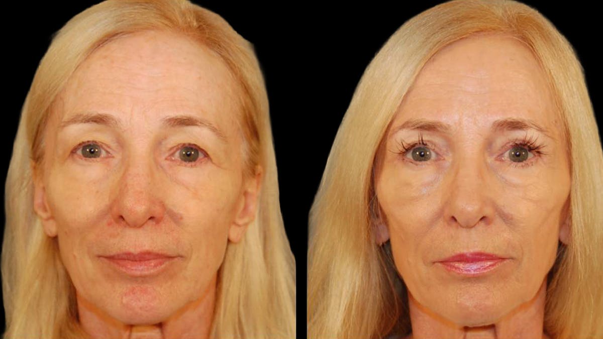 Upper Eyelid Surgery Before & After Gallery - Patient 260249 - Image 1