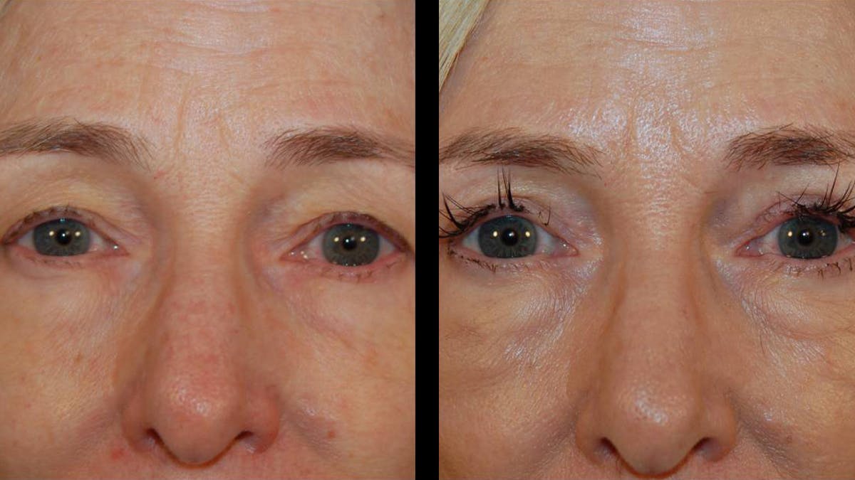 Upper Eyelid Surgery Before & After Gallery - Patient 260249 - Image 2