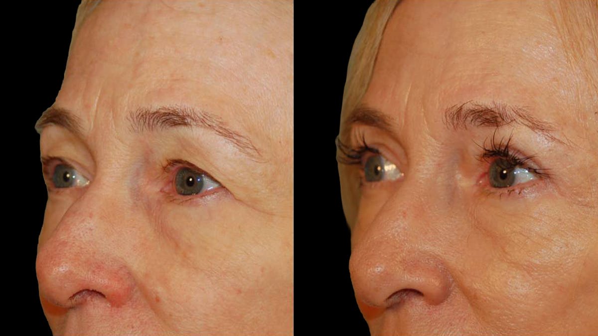 Upper Eyelid Surgery Before & After Gallery - Patient 260249 - Image 3
