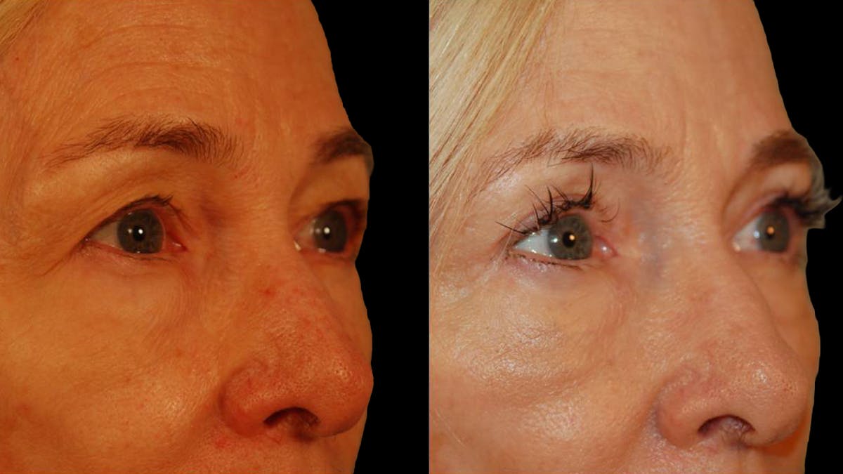 Upper Eyelid Surgery Before & After Gallery - Patient 260249 - Image 5