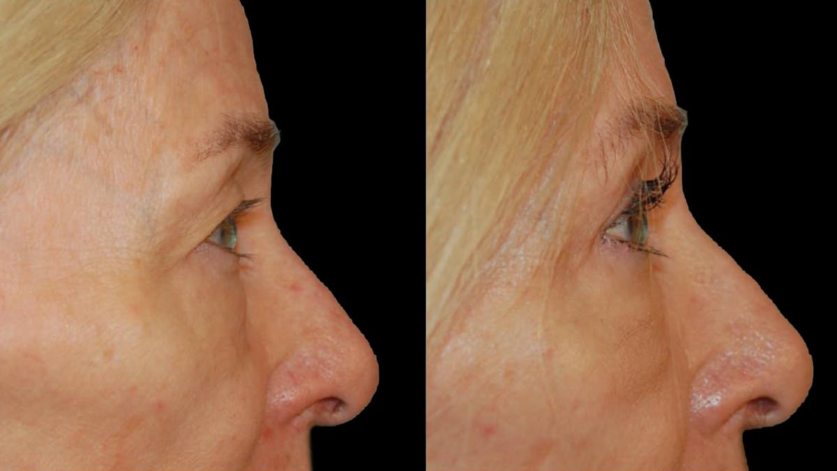 Upper Eyelid Surgery Before & After Gallery - Patient 260249 - Image 6