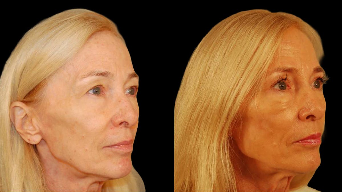 Upper Eyelid Surgery Before & After Gallery - Patient 260249 - Image 7