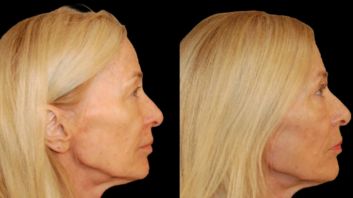 Upper Eyelid Surgery Before & After Gallery - Patient 260249 - Image 8