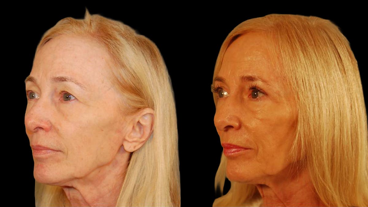 Upper Eyelid Surgery Before & After Gallery - Patient 260249 - Image 9