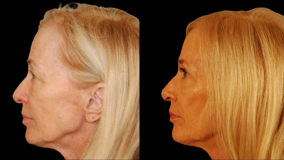 Upper Eyelid Surgery Before & After Gallery - Patient 260249 - Image 10