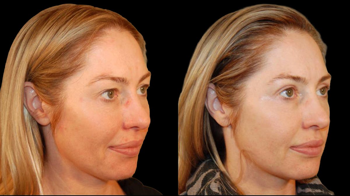 Upper Eyelid Surgery Before & After Gallery - Patient 318421 - Image 2