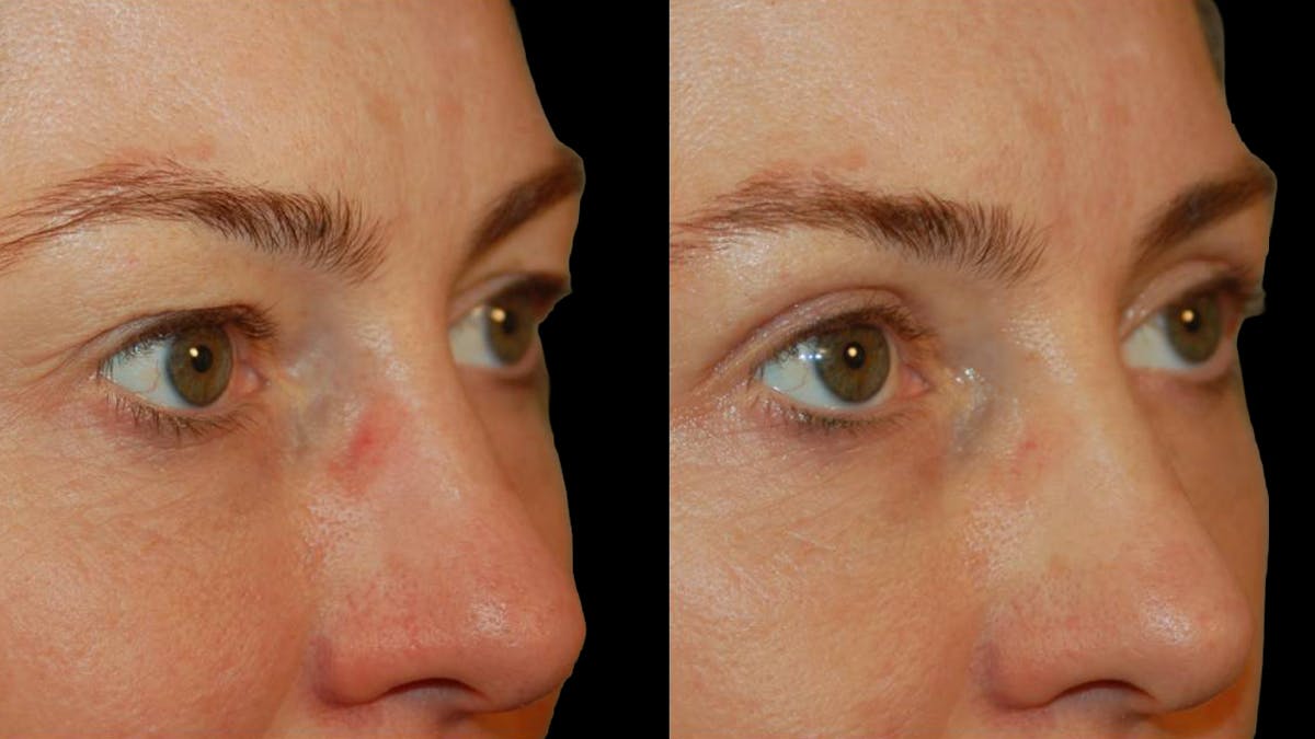 Upper Eyelid Surgery Before & After Gallery - Patient 318421 - Image 3