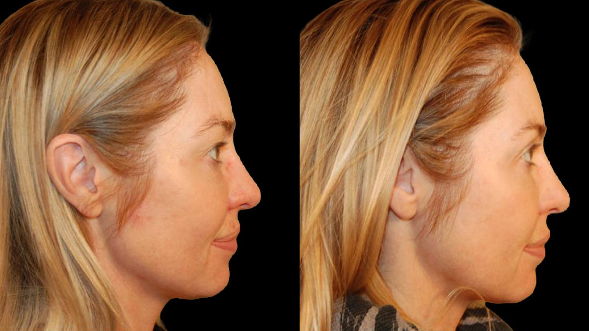 Upper Eyelid Surgery Before & After Gallery - Patient 318421 - Image 4