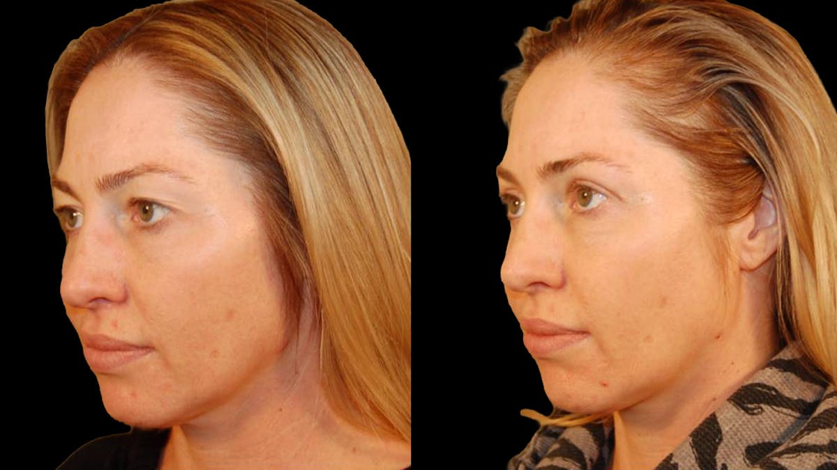 Upper Eyelid Surgery Before & After Gallery - Patient 318421 - Image 5