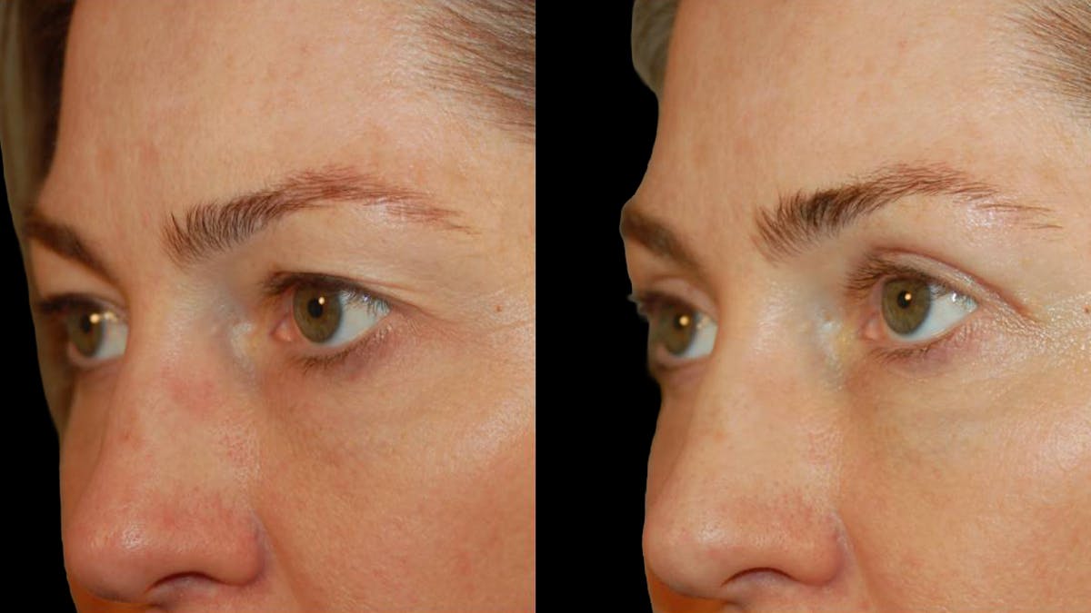 Upper Eyelid Surgery Before & After Gallery - Patient 318421 - Image 6