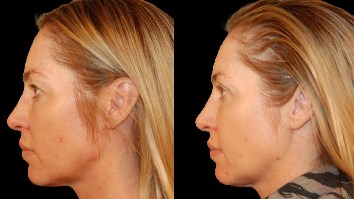 Upper Eyelid Surgery Before & After Gallery - Patient 318421 - Image 7