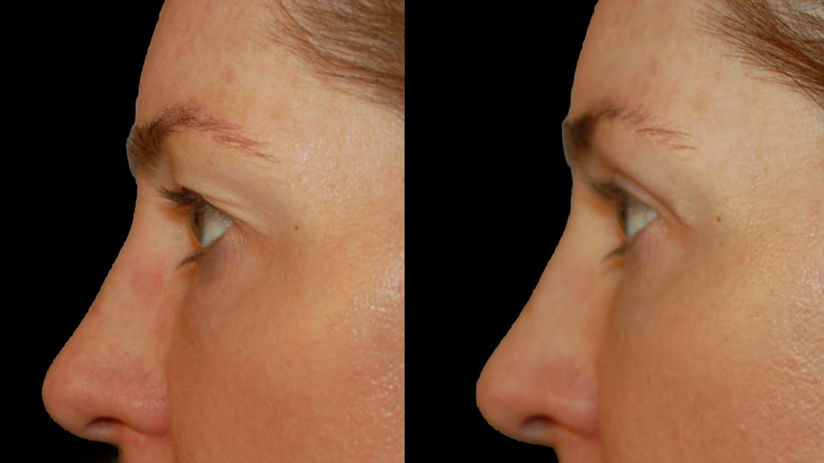 Upper Eyelid Surgery Before & After Gallery - Patient 318421 - Image 8