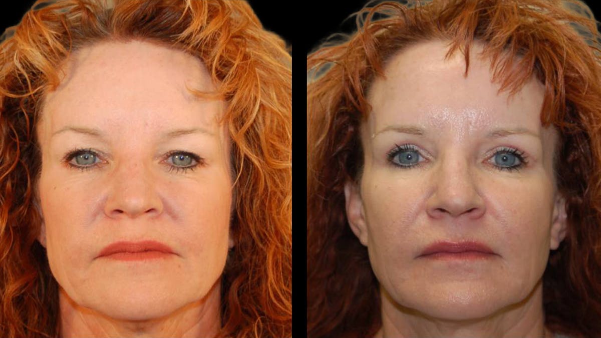 Upper Eyelid Surgery Before & After Gallery - Patient 102634 - Image 1