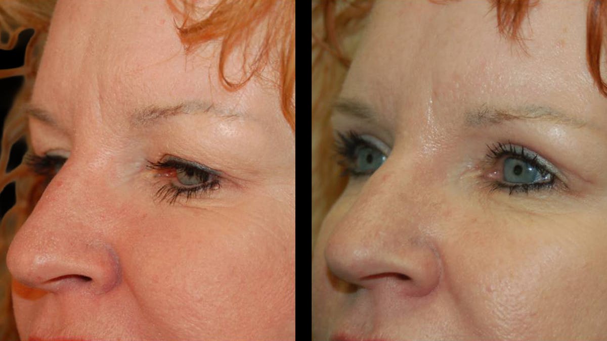Upper Eyelid Surgery Before & After Gallery - Patient 102634 - Image 3
